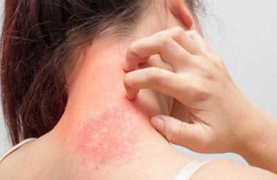 বিরক্তিকর অ্যালার্জি থেকে মুক্তির উপায়